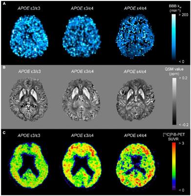 Quantitative susceptibility mapping as an imaging biomarker for Alzheimer’s disease: The expectations and limitations